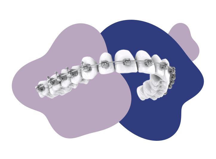 Traditional braces